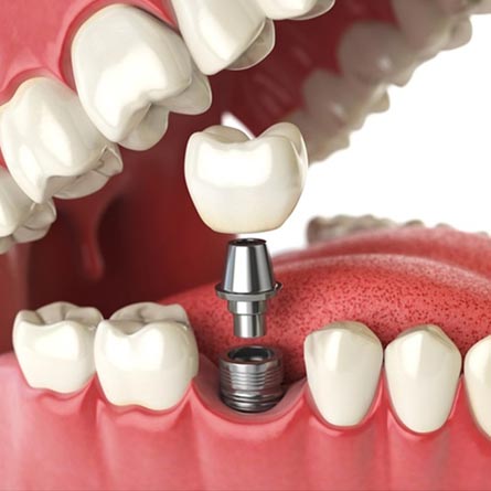 Dental Implants in Ranchi