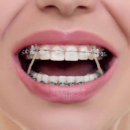 Orthodontics in Ranchi