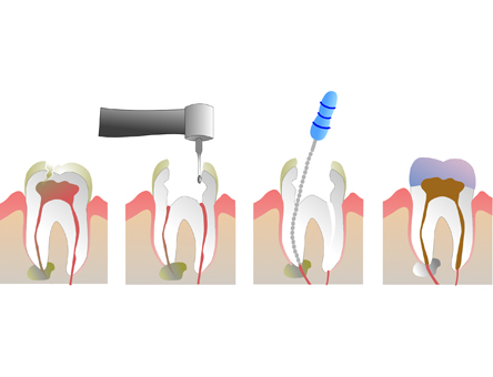 Root Canal in Ranchi