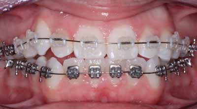 Orthodontist in Ranchi, Dental Implants in Ranchi, Sushruta Dental