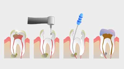 Best dentist in Ranchi, Dentist in Ranchi, endodontics