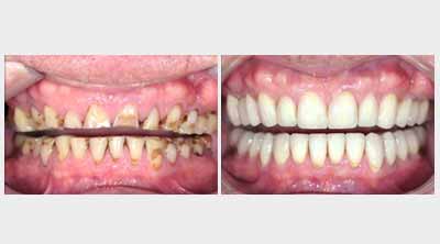 Dental Implants in Ranchi, Dentist in Gumla, Full Mouth Rehabilitation