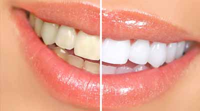 Dentist in Gumla, Dental clinic in Ranchi, Bleaching