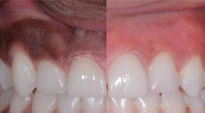 Dental Implants in Ranchi, Best dental clinic in Ranchi, De-pigmentation