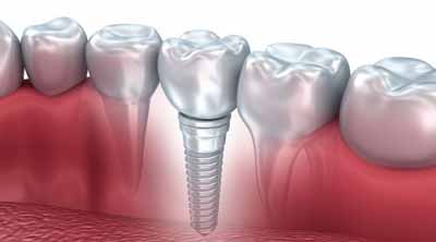 Dental hospital in Ranchi, Dental Implants in Ranchi, Sushruta Dental