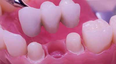 Dentist in Gumla, Best dental clinic in Ranchi, fixed prosthesis