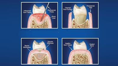 Dental clinic in Ranchi, Best dentist in Ranchi, periodontics