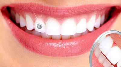 Dental clinic in Ranchi, Dentist in Ranchi, Dental jewellery